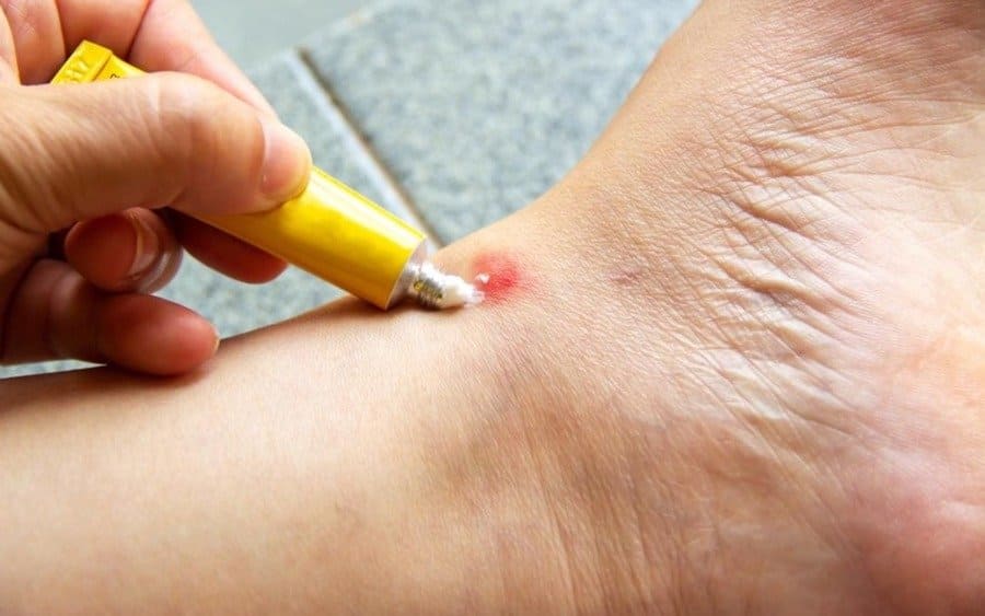 Someone applying an oral gel to a mosquito bite on his foot